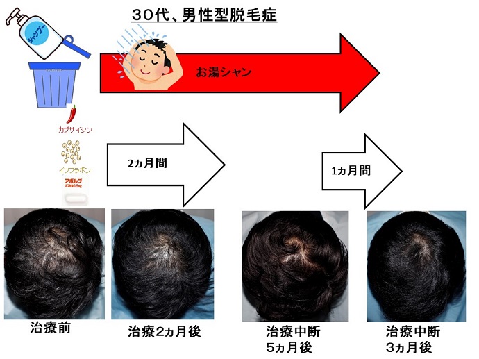 円形脱毛症　病院